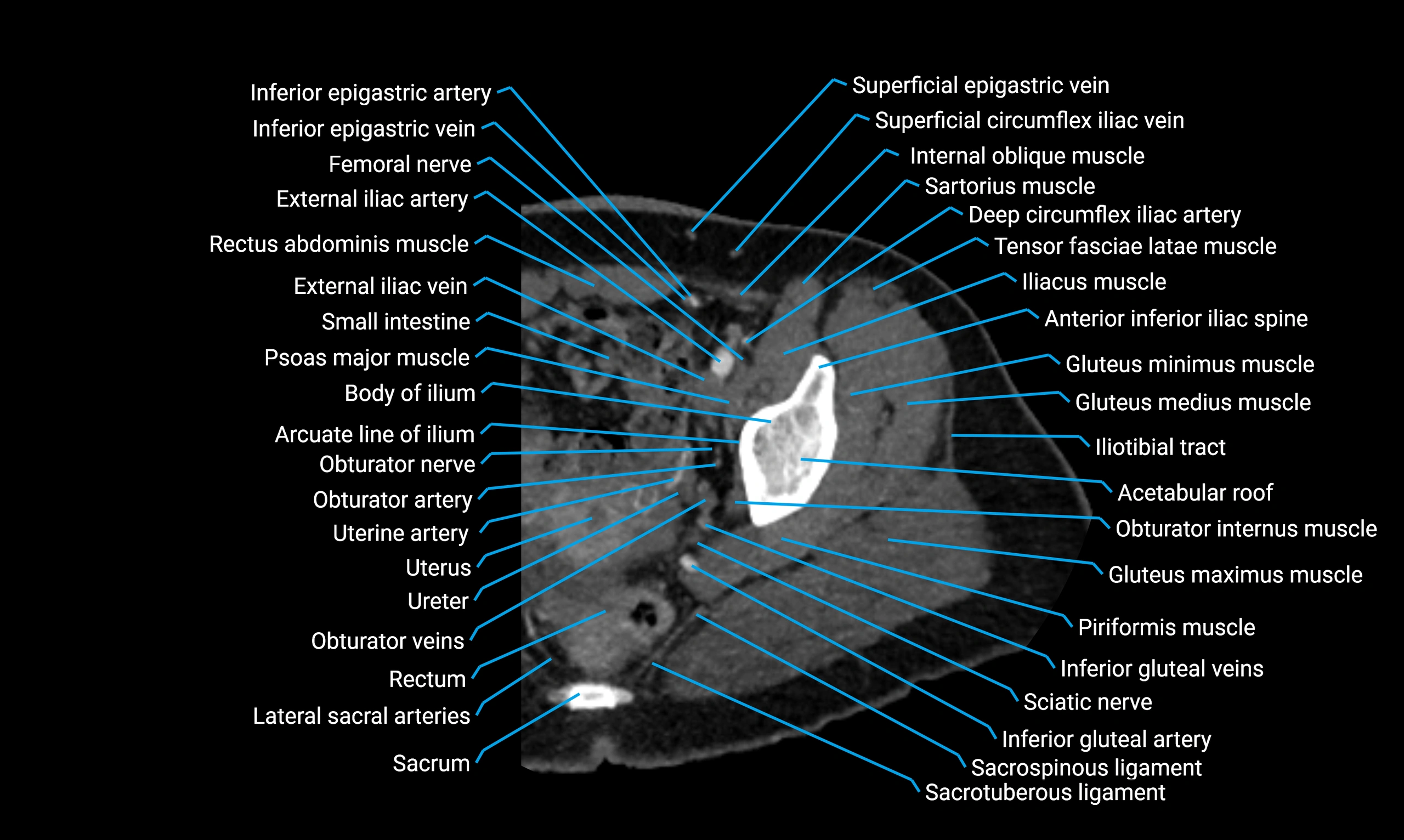 CT lower limb axial cross sectional anatomy labelled image 1 (4).webp